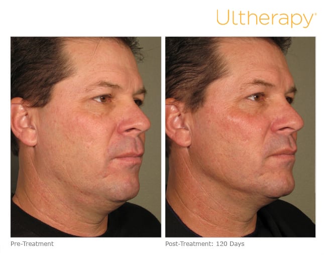 Ultherapy before and after