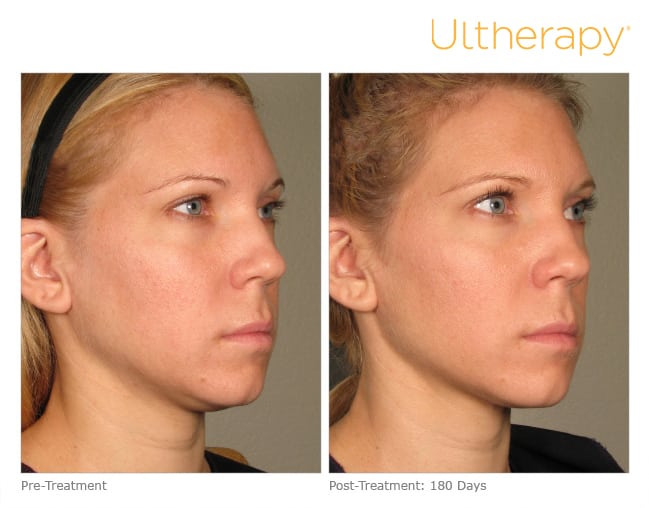 Ultherapy before and after