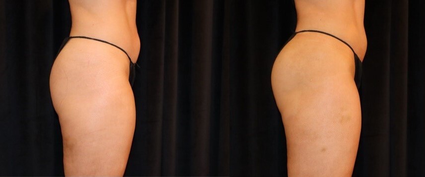 Before and after CoolTone on the buttocks, side view