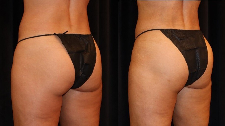 Before and after CoolTone on the buttocks, back view