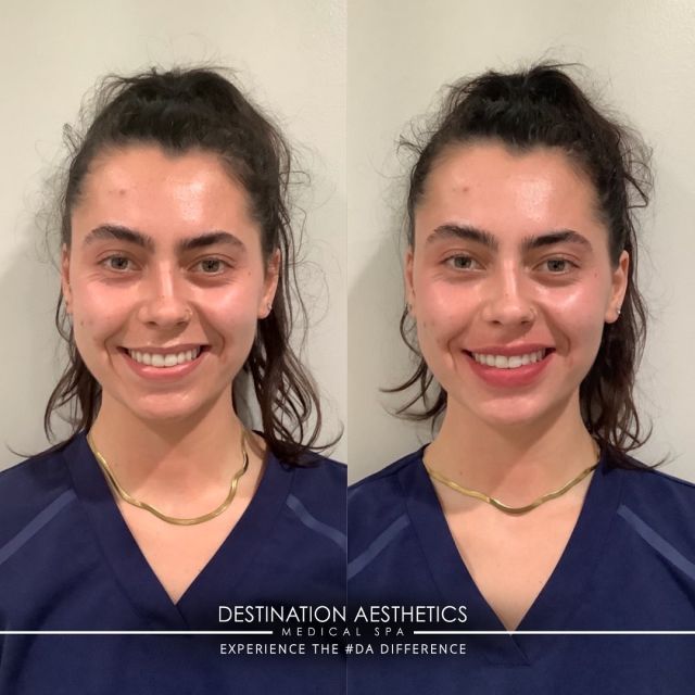 Smile, it’s almost the weekend 😄! This beautiful patient had her lips done by Nurse Injector, Veronica out of #DA Sacramento and absolutely LOVES them! ​​​​​​​​
​​​​​​​​
If you have been thinking about getting your lips done, this is the sign to just DO IT 🤩! Save $50 on your next syringe of @juvederm filler when you add “JUV50” to your appointment notes 📝. ​​​​​​​​
​​​​​​​​
📲 Call (916) 844-4913​​​​​​​​
💬 Text (916) 461-8001 ​​​​​​​​
💻 Book online via the link in our bio! ​​​​​​​​
​​​​​​​​
#lipfiller #lips #haileybieberlips #juvedermlips