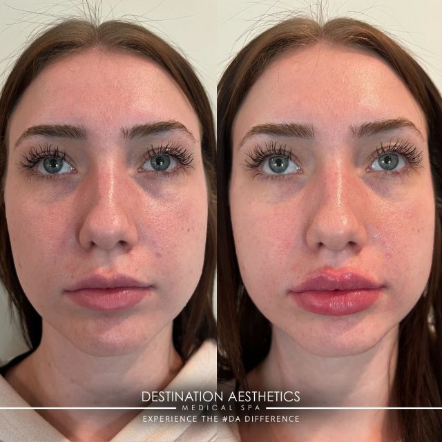 LIPS, LIPS, LIPS 👄!
⠀⠀⠀⠀⠀⠀⠀⠀⠀
We are in love with these gorgeous Restylane® Kysse lips by Shannon, RN out of #DA Roseville! 
⠀⠀⠀⠀⠀⠀⠀⠀⠀
What’s great about Restylane® Kysse? Not only does it add fullness and definition to the lips but it also improves the texture & color! 😍
⠀⠀⠀⠀⠀⠀⠀⠀⠀
To make an appointment: 
📲 Call (916) 844-4913
💬 Text (916) 461-8001
💻 Link in bio 
⠀⠀⠀⠀⠀⠀⠀⠀⠀
#restylanekysse #restylanelips #lipfiller #restylanelipfiller