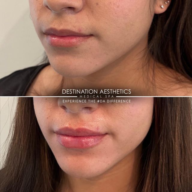 First time lip filler! Embracing a new level of confidence, one plump pout at a time 💋💉
⠀⠀⠀⠀⠀⠀⠀⠀⠀
Provider: Shannon, RN
Product Used: JUVÉDERM® ULTRA XC
Location: DA™ Roseville
⠀⠀⠀⠀⠀⠀⠀⠀⠀
JUVÉDERM® ULTRA XC is a great product for plumping up the lips. Have you been treated with JUVÉDERM® ULTRA XC before? Let us know in the comments below.👇🏽 
⠀⠀⠀⠀⠀⠀⠀⠀⠀
Results may vary as we are all uniquely different.
#juvedermcoopprogram #filler #fillerbeforeandafter
*Intended for US audiences only. For important safety information, see @juvederm