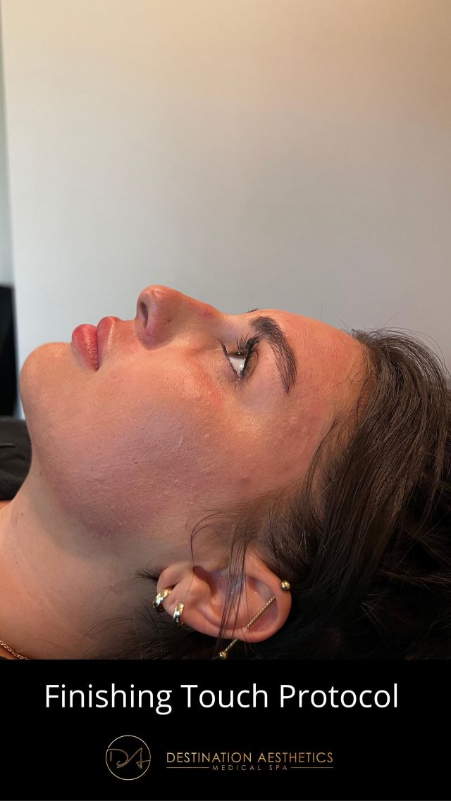 Worried about being out in public after your aesthetic treatments? Don’t worry, we got you! 💁🏽‍♀️😄
⠀⠀⠀⠀⠀⠀⠀⠀⠀
In all 5 of our locations, you can request the Finishing Touch™ Protocol by Colorescience or “FTP” be applied post treatment to help minimize discomfort and downtime while protecting and calming your upset, inflamed skin. And, it’s completely complimentary!
⠀⠀⠀⠀⠀⠀⠀⠀⠀
That’s not all! You also receive Lasting Beauty Reward Points for the ColoreScience® FTP products that were applied as long as you have an LBR account. To sign up, just ask the front desk before or after your appointment. 💖

SkinPen® treatment done by Roseville RN, Clarissa.
⠀⠀⠀⠀⠀⠀⠀⠀⠀
#colorescience #finishingtouchprotocol #lastingbeautyrewards