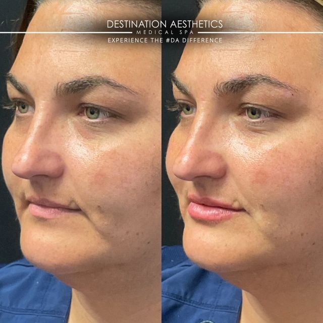 Filler, but Make it Natural! 🌟 
⠀⠀⠀⠀⠀⠀⠀⠀⠀
💉 In the right hands and with a skilled approach, filler can enhance your natural beauty, leaving you looking refreshed and rejuvenated.
⠀⠀⠀⠀⠀⠀⠀⠀⠀
✨ Injector: Demetria, RN 
📍 Location: #DA Folsom 
💉 Product Used: JUVÉDERM® VOLBELLA® XC
👄 Area Injected: Lips 
⠀⠀⠀⠀⠀⠀⠀⠀⠀
DON’T FORGET! Buy one syringe of lip filler, get a #DA lip plumper + Botox® Lip Flip FREE* until 11.30.23! Click the link in our bio to purchase! 
*Must have both lip filler + lip flip done during same appointment. 
⠀⠀⠀⠀⠀⠀⠀⠀⠀
Results may vary as we are all uniquely different.
#juvedermcoopprogram #filler #fillerbeforeandafter
*Intended for US audiences only. For important safety information, see @juvederm