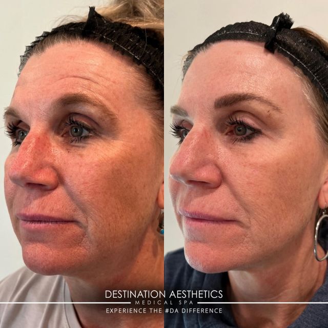 It’s the skin quality for us 😍 > 
⠀⠀⠀⠀⠀⠀⠀⠀⠀
1 month post:
✨ 1 treatment* of SKINVIVE®
✨ 40 units of Botox®**
✨ Even & Correct Serum by SkinMedica® 
⠀⠀⠀⠀⠀⠀⠀⠀⠀
*1 treatment of SKINVIVE® = 2 syringes. $700/treatment or $500/treatment if being added onto another service. 
**20 units to her glabella (between the brows) + 20 units to her frontalis (forehead). 
⠀⠀⠀⠀⠀⠀⠀⠀⠀
💉 Provider: Clarissa, RN out of #DA Roseville 
⠀⠀⠀⠀⠀⠀⠀⠀⠀
To book with Clarissa: 
📲 Call (916) 844-4913
💬 Text (916) 461-8001
💻 Link in bio 
⠀⠀⠀⠀⠀⠀⠀⠀⠀
⠀⠀⠀⠀⠀⠀⠀⠀⠀
#skinvive #skinquality #beforeandafterbotox #skinmedica